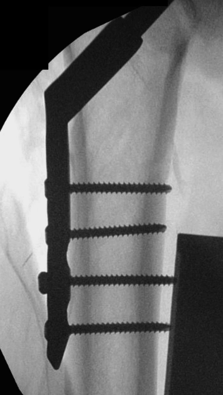 This anteroposterior (AP) x-ray radiography shows an intraoperative view of the proximal femur following internal fixation of a hip fracture. The image demonstrates a metallic Dynamic Hip Screw (DHS) system in situ. The implant consists of a long lag screw inserted through the femoral neck towards the femoral head and a lateral side plate fixed to the femoral shaft. The side plate is secured to the lateral cortex using four bicortical screws, oriented parallel to each other and perpendicular to the long axis of the plate. The bone quality exhibits increased radiolucency consistent with osteoporotic changes, and the fracture site (previously identified as intertrochanteric) is stabilized by the hardware. This visual serves as an educational example of orthopedic surgical management for AO type A1.2 intertrochanteric fractures, highlighting the correct placement and component relationship of a DHS implant for medical students and residents.