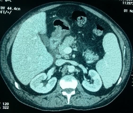 This diagnostic image is an axial contrast-enhanced abdominal computerized tomography (CT) scan focusing on the upper abdominal organs. The scan demonstrates clinical signs of acute pancreatitis. Key findings include visible infiltration and stranding of the peripancreatic fat, particularly noted as increased attenuation in the interpancréatico-duodenal region. The pancreas itself shows signs of inflammatory densification. Notably, the biliary system appears normal; the main bile duct (common bile duct) is not distended, the intra- and extra-hepatic bile ducts are fine, and the pancreatic duct (canal of Wirsung) is not dilated. Other visible landmarks include the liver, spleen, both kidneys, and a cross-section of the lumbar vertebra and aorta. This imaging is characteristic of Balthazar Grade B/C pancreatitis, illustrating the absence of significant fluid collections or biliary obstruction while highlighting localized fat-plane effacement indicative of acute inflammation.