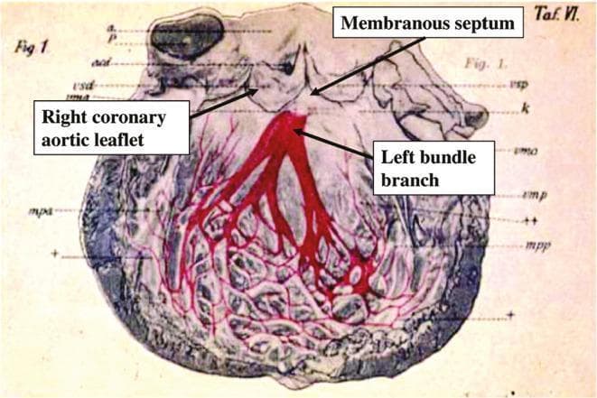 This anatomical diagram illustrates the cardiac conduction system within the left ventricle of a human heart. The visual highlights the left bundle branch (LBB) and its subsequent fascicular branching patterns, rendered in a bold red color against a neutral-toned anatomical background. Key structures identified via labels include the membranous septum and the right coronary aortic leaflet, providing critical landmarks for the origin of the left bundle. The diagram depicts the hierarchical organization of the conduction fibers, showing how the main left bundle branch emerges near the membranous septum and diverges into anterior and posterior divisions. These divisions further subdivide into an intricate, reticular network of Purkinje fibers that spread extensively across the ventricular myocardium. This illustration serves an educational purpose in cardiology and anatomy, demonstrating the subendocardial distribution of the electrical pathways responsible for synchronous ventricular contraction.