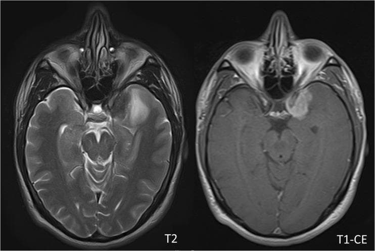 Diagnostic axial MRI of the brain comparing T2-weighted and T1-weighted contrast-enhanced (T1CE) sequences in a 41-year-old male with a WHO Grade II meningioma. The lesion is located at the left medial sphenoid wing. On the T2-weighted image (left), the tumor presents as a hyperintense (bright) mass with well-defined borders and associated mild peritumoral edema, visible as a surrounding high-signal intensity region in the adjacent brain parenchyma. On the T1CE image (right), the meningioma demonstrates intense, relatively homogeneous gadolinium enhancement, characteristic of this extra-axial tumor entity. The anatomical region clearly shows the skull base, temporal lobes, and brainstem. This image pair serves as an educational example of how different MRI sequences highlight specific tumor characteristics: T2 for evaluating peritumoral edema and T1CE for assessing vascularity and tumor margins through contrast uptake. This comparison is clinically significant for neuroradiological assessment and neurosurgical planning for skull base tumors.
