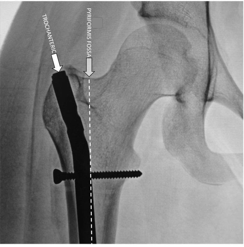 This diagnostic image is an anteroposterior (AP) X-ray radiograph of the proximal femur and hip joint, demonstrating the surgical placement of a modern trochanteric-entry antegrade intramedullary (IM) rod. The radiopaque metal rod is visible extending through the intramedullary canal of the femoral shaft. A key educational feature is the comparison of entry points: an arrow labeled 'TROCHANTERIC' points to the lateral tip of the greater trochanter where the rod enters, while a dotted vertical line and a second arrow labeled 'PYRIFORMIS FOSSA' indicate the traditional, more medial entry site. A proximal interlocking screw is seen traversing the rod horizontally through the femoral shaft below the lesser trochanter to provide rotational stability. This visual emphasizes the anatomical landmarks used in orthopedic surgery to mitigate risks of iatrogenic osseous necrosis by utilizing a trochanteric entry point, which maintains a safer distance from the circumflex vessels compared to the piriformis fossa entry.