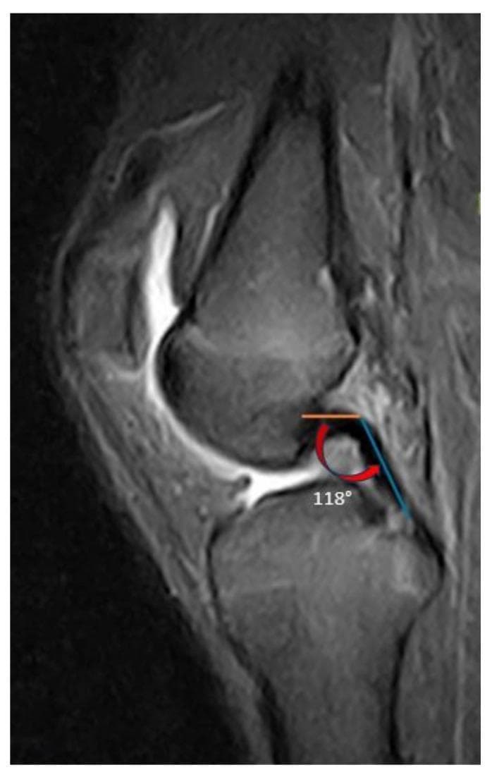 This diagnostic image is a T2-weighted sagittal MRI view of a human knee joint, illustrating the measurement of the Posterior Cruciate Ligament (PCL) buckling angle. The anatomical focus includes the distal femur, proximal tibia, patella, and the intra-articular ligaments. The PCL is highlighted as a low-signal (dark) band extending from its femoral attachment to its tibial insertion. Superimposed on the MRI are two geometric lines: an orange line following the proximal femoral portion of the PCL and a blue line following the distal tibial portion. A red curved arrow indicates the vertex where these lines intersect, with a displayed measurement of 118 degrees. This radiological measurement is used in orthopedic surgery and sports medicine to evaluate PCL morphology and ligamentous laxity, which can be secondary to anterior cruciate ligament (ACL) insufficiency or posterior tibial slope variations. The image serves as an educational reference for quantitative assessment of cruciate ligament orientation in the sagittal plane.