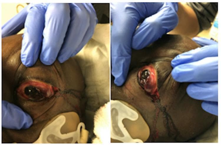 Clinical photographs in frontal (A) and lateral (B) views demonstrating the post-procedural appearance of a lateral canthotomy and inferior cantholysis performed for orbital compartment syndrome. The images show a 57-year-old male with significant proptosis and chemosis of the left eye. In view A, the surgical incision at the lateral canthus is visible, with marked erythema and edema of the periorbital tissues. In view B, the lateral profile emphasizes the degree of globe protrusion (proptosis) and reveals surgical trauma with minor bleeding and tissue disruption at the lateral commissure where the canthal tendons were incised. Blue-gloved hands are seen retracting the upper and lower eyelids to expose the ocular surface and surgical site. This visual documentation serves to illustrate the emergency surgical management required to reduce intraocular pressure and prevent permanent vision loss in cases of retrobulbar pressure buildup.