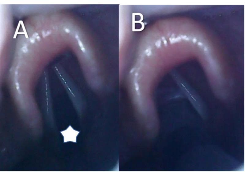 Two side-by-side videolaryngoscopy images (labeled A and B) demonstrating a Cormack-Lehane Grade I view during a general anesthesia induction. Image A displays an open glottis, marked with a white star, showing clearly visible and separated vocal cords and a patent airway. The surrounding laryngeal anatomy, including the epiglottis and arytenoid cartilage regions, appears healthy and without structural anomalies. Image B illustrates the subsequent procedural step: the introduction of an endotracheal tube (ETT). The ETT is visible passing through the glottic opening between the vocal cords, ensuring correct intratracheal placement for mechanical ventilation. These images serve as an educational example of successful video-assisted laryngoscopy and intubation technique in a pediatric patient with craniofacial sequelae (cleft lip and palate).