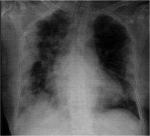 This diagnostic image is an anteroposterior (AP) chest X-ray demonstrating a case of viral pneumonia complicated by Acute Respiratory Distress Syndrome (ARDS). The radiograph reveals diffuse, bilateral, patchy alveolar opacities and ground-glass infiltrates. The abnormalities are primarily concentrated in the peripheral and basal regions of both lung fields, a hallmark distribution often seen in COVID-19 pneumonia. There is evidence of more confluent consolidation in the left lung compared to the right, particularly involving the lower lobe. The cardiac silhouette appears moderately enlarged, and the mediastinal contours are visible despite the overlapping pulmonary infiltrates. This image serves as an educational example of progressive pulmonary parenchymal involvement in severe respiratory infections, illustrating the typical radiographic progression from localized opacities to multi-lobar consolidation characteristic of clinical ARDS.