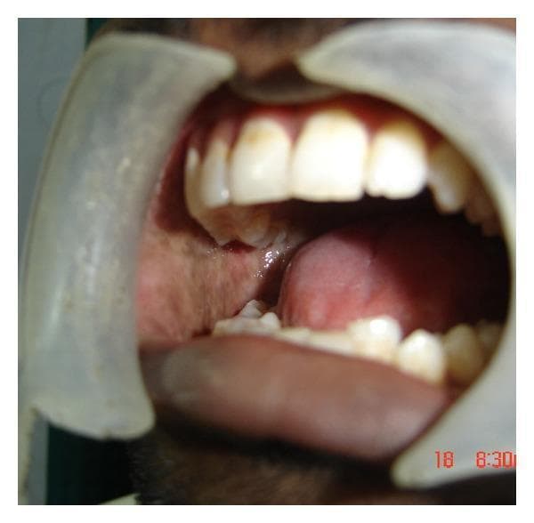 This clinical photograph shows an intraoral view of a patient with oral submucous fibrosis (OSMF). The image features the buccal mucosa, which appears markedly pale and blanched, with visible whitish, fibrotic bands replacing the healthy pink mucosal tissue. These changes are characteristic of chronic, progressive scarring. Retractors are used to expose the oral cavity, revealing a significantly restricted mouth opening (trismus), indicated by the limited interincisal distance between the maxillary and mandibular teeth. While the dentition and tongue are visible, their movement and the overall aperture are constrained by the underlying submucosal fibrosis. This image demonstrates the preoperative clinical presentation of OSMF, highlighting the loss of mucosal elasticity and restricted oral motility associated with this condition.