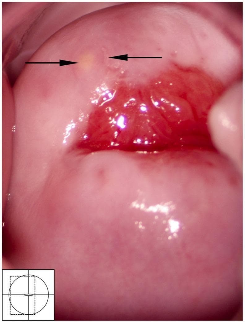 This colposcopic image provides a detailed view of the human cervix, centered on the external os and the transformation zone. On the anterior lip of the cervix, approximately at the 11 o'clock position (indicated by the left arrow), a small, circular, yellow-colored Nabothian cyst is visible. The cyst appears as a smooth, localized elevation representing mucus retention beneath metaplastic squamous epithelium. Adjacent to the cyst (indicated by the right arrow), there is a small, irregular area of off-white leukoplakia, which represents a mucosal abnormality. The central region surrounding the cervical os shows physiological erythema typical of the columnar epithelium. This clinical photograph is used in medical education to differentiate benign findings like Nabothian cysts from other cervical pathologies, such as those associated with female genital schistosomiasis, herpes simplex virus, or cervical intraepithelial neoplasia (CIN).