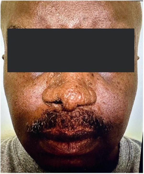 This clinical photograph shows the frontal view of a patient with cutaneous sarcoidosis, specifically lupus pernio, following systemic treatment. The image focuses on the mid-face region, including the nose, cheeks, and upper lip. While there is evidence of post-inflammatory texture changes and some subtle residual thickening, there is a marked absence of the highly characteristic indurated, violaceous, or reddish-brown shiny nodules and plaques typically seen in active lupus pernio. The nasal bridge and alae appear relatively smooth and the previous bulbous distortion has largely resolved. The skin tone on the cheeks and perioral area is more uniform, though some mild follicular prominence and chronic scarring may persist. This image serves as an educational example of the therapeutic response of cutaneous sarcoidosis to Janus kinase (JAK) inhibitor therapy, illustrating the significant reduction in granulomatous infiltration and the restoration of normal facial contours.