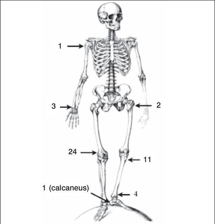 This anatomical diagram presents an anterior view of the human skeletal system, designed as a schematic for mapping orthopedic pathologies such as Giant Cell Tumors (GCT). The illustration features key skeletal components including the skull, axial skeleton (rib cage and vertebrae), pelvis, and appendicular skeleton (upper and lower extremities). Specific anatomical locations are identified with numbered arrows: 1 (proximal humerus/shoulder), 2 (proximal femur/hip), 3 (distal radius/wrist), 24 (distal femur/knee), 11 (proximal tibia), 4 (distal fibula/ankle), and a second label 1 identifying the calcaneus. The diagram serves as a clinical mapping tool to visualize the distribution of bone lesions and helps correlate radiographic classifications, such as Campanacci's bone destruction stages, with specific anatomical sites. It is intended for musculoskeletal oncology education and diagnostic reporting.