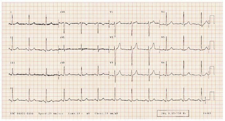 This diagnostic image shows a standard 12-lead electrocardiogram (ECG) recorded on a red-grid thermal graph paper. The layout is organized into four columns and three rows, supplemented by a continuous rhythm strip (typically lead II) along the bottom. The first column displays the limb leads (I, II, III), the second column shows the augmented limb leads (aVR, aVL, aVF), and the third and fourth columns display the precordial chest leads (V1–V3 and V4–V6, respectively). Each lead waveform clearly demonstrates standard cardiac cycle components: the P wave (atrial depolarization), the QRS complex (ventricular depolarization), and the T wave (ventricular repolarization). The grid background allows for clinical measurements, where each small 1 mm square represents 0.04 seconds horizontally and 0.1 mV vertically. The traces show a normal sinus rhythm with regular intervals and consistent morphology, used in cardiology to screen for arrhythmias, conduction delays, or ischemic heart disease.