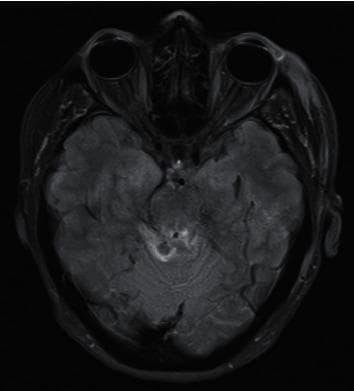 This diagnostic image is an axial Fluid-Attenuated Inversion Recovery (FLAIR) MRI of the brain at the level of the midbrain. The scan demonstrates characteristic features of Grade III Diffuse Axonal Injury (DAI). Key visual findings include multiple focal areas of hyperintense signal (hyperintensities) indicative of traumatic axonal shearing and localized edema. These lesions are specifically localized to the bilateral tectum of the midbrain and the periaqueductal gray matter. Additional hyperintense signal is visible extending into the superior cerebellar parenchyma and the superior cerebellar peduncles. The presence of these deep-seated lesions in the brainstem and cerebellar structures is a hallmark of severe traumatic brain injury (TBI). The surrounding cortical structures and ventricles are visible but secondary to the prominent brainstem pathology. This visual evidence serves as a critical educational tool for identifying the radiological progression and grading of shearing injuries in the setting of trauma neurology and neuroradiology.