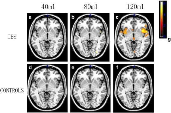 This diagnostic image set consists of axial functional MRI (fMRI) scans comparing brain activation patterns between patients with Irritable Bowel Syndrome (IBS) and healthy controls during graded visceral stimulation. The images are arranged in a grid corresponding to rectal balloon distention volumes of 40ml, 80ml, and 120ml. A colorimetric scale (g) indicates activation intensity, where lighter yellow/white colors represent higher signal changes and darker red/orange colors represent lower changes. In the IBS group (a-c), there is a volume-dependent increase in cortical activation; at 120ml (c), prominent activation is visible in the prefrontal cortex, insular cortex, and parietal regions. In contrast, the control group (d-f) shows minimal to no significant brain activation across all three stimulation volumes. This comparison illustrates the pathophysiology of visceral hypersensitivity and altered central pain processing in IBS patients, demonstrating an exaggerated neural response to mechanical bowel distention compared to healthy subjects.