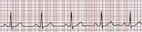 This diagnostic image displays a continuous electrocardiogram (ECG) rhythm strip, illustrating several cardiac cycles on standard red-grid paper. The waveform demonstrates a regular sinus rhythm characterized by distinct morphological components: a small, rounded P wave signifying atrial depolarization, followed by a narrow, high-amplitude QRS complex representing ventricular depolarization. The QRS complex consists of a sharp upward R-wave with a standard voltage peak near 1 mV. Subsequent to the QRS complex is a broad, positive T wave indicating ventricular repolarization. The image illustrates consistent R-R intervals, indicating a steady heart rate, and stable PR and QT intervals. This physiological signal serves as a fundamental educational example of cardiac electrical activity, highlighting the temporal and amplitude relationships necessary for clinical assessment in cardiology. The grid allows for the measurement of voltage (vertical axis) and time (horizontal axis), essential for identifying arrhythmias or conduction abnormalities.