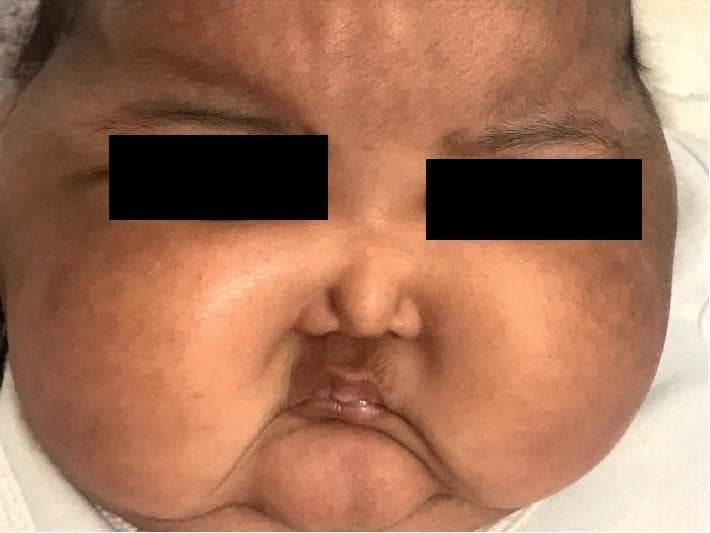 This clinical photograph shows a close-up facial view of an infant demonstrating classic 'moon facies,' a characteristic finding associated with Cushing syndrome or systemic corticosteroid exposure. The face exhibits a markedly rounded, plethoric, and symmetrical appearance due to subcutaneous fat redistribution and edema. Notable features include prominent, puffed cheeks (buccal fat pad hypertrophy) that obscure the jawline and give the face a circular contour. The central facial features, specifically the nose and mouth, appear small and recessed relative to the enlarged, convex cheeks. The eyes are partially obscured by periorbital puffiness, and the forehead appears broad. This visual finding is a key diagnostic indicator for hypercortisolism, which in this clinical context is related to the iatrogenic absorption of potent topical steroids used for diaper dermatitis.
