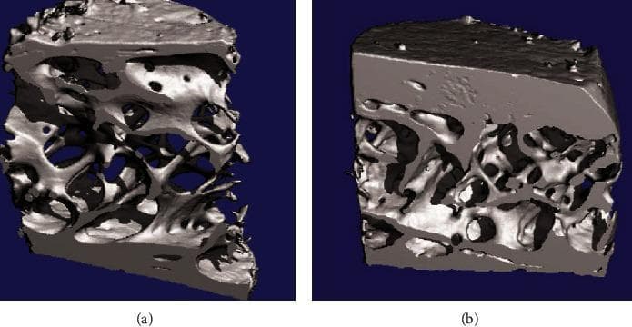 This diagnostic image displays 3D micro-computed tomography (micro-CT) reconstructions of transiliac bone biopsies from postmenopausal women, illustrating the microstructural effects of osteoporosis treatment. The side-by-side comparison focuses on the trabecular and cortical bone architecture. Panel (a) shows the bone microstructure after 36 months of strontium ranelate therapy, characterized by a more open trabecular network with visible connectivity and thickness of individual trabeculae. Panel (b) represents the placebo group, demonstrating a contrasting bone density and architecture. The educational focus is on identifying changes in bone mineral density (BMD) and the preservation of trabecular microarchitecture, which are critical markers in assessing the efficacy of anti-osteoporotic pharmacological interventions. Key visible features include the porosity of the cancellous bone, the thickness of the cortical shell, and the overall structural integrity of the bone matrix. This material is highly relevant for medical education in rheumatology, endocrinology, and orthopedics, specifically regarding the diagnosis and management of postmenopausal osteoporosis.