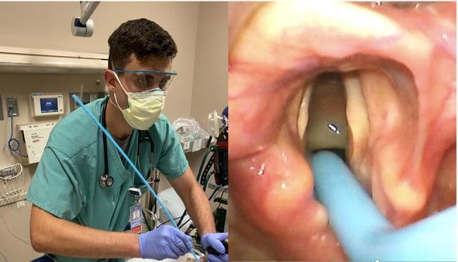 This composite clinical photograph illustrates an endotracheal intubation procedure using a tracheal tube introducer (bougie). The left panel shows the clinical setup where an emergency medicine resident, in appropriate personal protective equipment (mask, eye protection, and gloves), is performing the procedure. He is holding a blue bougie with his right arm adducted to optimize the angle of insertion. The right panel displays the corresponding real-time video laryngoscope view within the oropharynx. This internal view reveals the epiglottis, arytenoids, and the vocal cords (Cormack-Lehane Grade 2a). The blue tip of the bougie is visible passing through the glottic opening into the trachea, demonstrating successful placement. The content emphasizes the relationship between clinician ergonomics, specifically shoulder position, and the successful navigation of airway adjuncts during rapid sequence intubation (RSI) for respiratory failure.