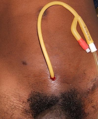 This clinical photograph shows a percutaneous suprapubic cystostomy (SPC) in a male patient. A yellow latex Foley catheter is seen entering the lower abdominal wall midline, approximately 2 centimeters superior to the symphysis pubis. The insertion site shows a small amount of serosanguinous fluid, typical of a recent procedural entry point. The distal end of the catheter features a classic Y-shaped bifurcation: one port, marked with '16FR', is connected to a clear urinary drainage tube via a white plastic connector, while the side port used for balloon inflation is equipped with a red-orange valve. This visual serves as an educational example of a suprapubic catheter placement for temporary or permanent bladder drainage in cases of urinary retention where urethral catheterization is contraindicated or unsuccessful. The image highlights the anatomical positioning and the physical components of the catheter hardware in a post-operative clinical setting.