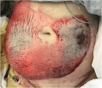 This clinical photograph displays a large, mixed-depth friction burn on the anterior abdomen of a patient following a motor vehicle accident. The injury covers a significant Total Burn Surface Area (TBSA), estimated at 13%. The wound exhibits heterogeneous characteristics: peripheral regions show intense erythema and mottled pink-to-red discoloration consistent with partial-thickness (second-degree) burns. Central and dependent areas of the wound demonstrate darker, grayish-black eschar and leathery texture, indicating full-thickness (third-degree) tissue damage covering approximately 4% of the TBSA. The burn follows a circular pattern around the umbilicus, which remains relatively spared. Visual signs of mechanical friction, such as linear abrasions and uneven texture, are evident throughout the injured area. This image serves as an educational example of high-energy friction trauma, illustrating the variable depths of thermal and mechanical skin injury and the clinical indicators used to differentiate between partial and full-thickness burns in a trauma setting.