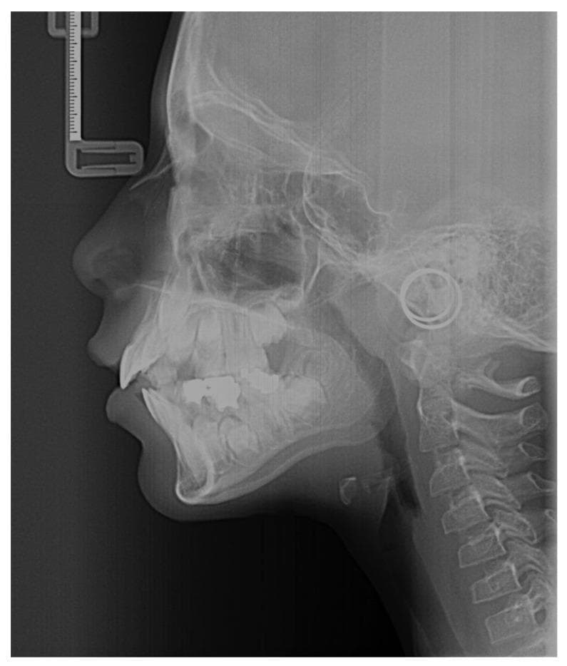 This diagnostic image is a lateral cephalometric radiograph, a specialized extraoral x-ray used primarily in orthodontics and maxillofacial surgery. The radiograph displays a lateral view of the human skull, including the facial bones, mandible, and maxilla. Visible anatomical landmarks include the sella turcica, nasal bone, and the anterior and posterior nasal spines. The dental arches are shown with evident dental restorations (radiopaque fillings). Importantly for skeletal maturity assessment, the cervical vertebrae (C2-C4) are clearly visible, showing the morphology of the vertebral bodies and inferior borders used in the Cervical Vertebral Maturation (CVM) method. The soft tissue profile is outlined, depicting the contours of the nose, lips, and chin relative to the underlying skeletal structures. Radiographic artifacts are present, including a nasion relator (ruler) near the frontal bone and ear rods (circular radiopaque markers) near the external auditory meatus to ensure standardized positioning.