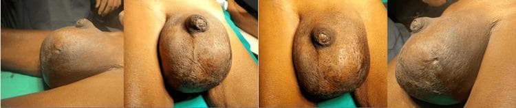 A series of four clinical photographs showing preoperative views of a massive, unilateral swelling of the left scrotum in an adult male. The swelling is approximately 25 x 15 cm, causing significant distortion and displacement of the penile shaft. The skin over the affected area is tense and shiny with a notable loss of normal scrotal rugosities (wrinkles), indicating severe distension. A visible cutaneous scar is present on the inferior aspect of the left hemiscrotum, consistent with a history of previous aspiration. The swelling is well-circumscribed, and the overlying skin appears hyperpigmented compared to the surrounding inguinal and thigh regions. This image illustrates the clinical presentation of chronic massive scrotal swelling, requiring differential diagnosis between giant hydrocele, pyocele, or a testicular neoplasm. The educational focus is on the physical examination findings of scrotal pathology, including changes in skin texture and topographical anatomy.