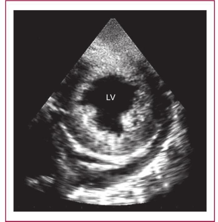 This diagnostic ultrasound image presents a short-axis echocardiographic view of the left ventricle (LV) in a patient with endomyocardiopericardial fibrosis (EMPF). The image demonstrates a characteristic three-layered 'layering' effect of the posterior cardiac wall. The innermost layer, the endocardium, appears as a dense, intensely hyperechoic (bright) band that is significantly thickened, engulfing the posterior papillary muscle. Adjacent to this is the myocardium, which maintains a distinct, less echogenic texture. The outermost layer shows a densely fibrosed and calcified pericardium, characterized by high-intensity echoes. An associated pericardial effusion is visible as an anechoic (dark) space between the myocardial and pericardial layers. This combination of endocardial thickening, myocardial preservation, and pericardial involvement is pathognomonic for advanced stages of endomyocardial fibrosis (EMF), often leading to restrictive or constrictive cardiac physiology.