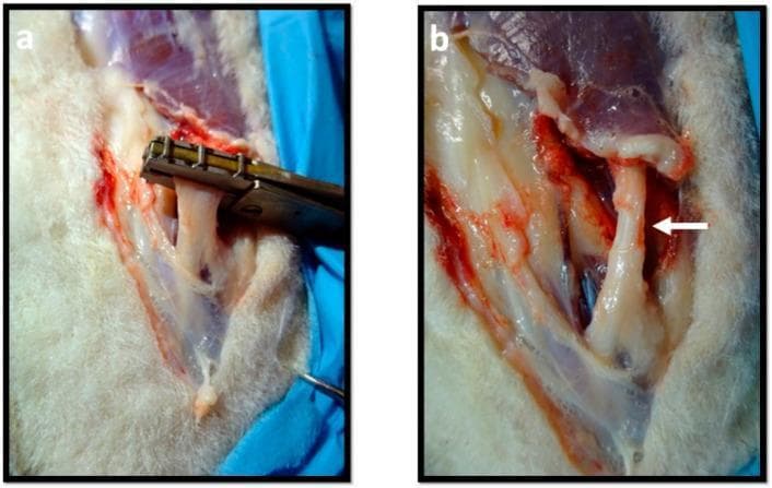This clinical photograph set illustrates the induction of an experimental axonotmesis (crush injury) on a peripheral nerve, likely the common peroneal nerve. Panel (a) shows the intraoperative procedure where a specialized metallic, non-serrated clamp with a flat crushing surface is applied perpendicular to the long axis of a taut, whitish nerve bundle. The clamp is used to apply a controlled compressive force to disrupt the axons while maintaining the continuity of the connective tissue sheaths (epineurium and perineurium). Panel (b) depicts the nerve immediately after the removal of the instrument. A white arrow highlights the resulting pathology: a distinct, flattened, and narrowed region corresponding to the crush site. This morphology demonstrates the visual characteristics of a Seddon's second-degree nerve injury. The surgical site shows surrounding muscular tissue and minor hemorrhage, providing a clear demonstration of nerve trauma models used to study peripheral nerve regeneration and functional recovery.
