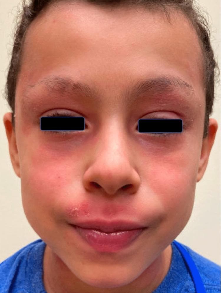 This clinical photograph shows the face of a pediatric patient exhibiting features of head and neck dermatitis (HND). The image displays diffuse erythema across the mid-face, including the cheeks and nasal bridge. Notably, there are erythematous plaques on the superior and inferior eyelids bilaterally, accompanied by mild edema and fine scaling. The perioral region demonstrates significant involvement, characterized by erythema and a localized cluster of pustules with honey-colored crusting lateral to the left oral commissure, suggestive of secondary impetiginization. The lips appear mildly inflamed and dry. This visual presentation is consistent with dupilumab-associated head and neck dermatitis, a known paradoxical reaction in patients treated for atopic dermatitis. The image serves as an educational example of regional dermatitis and secondary bacterial or fungal complications in the context of systemic immunomodulatory therapy. Clinical significance includes recognizing the distribution patterns that distinguish HND from primary flares of atopic dermatitis.
