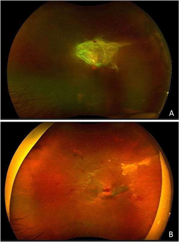 This clinical comparison chart presents two wide-field fundus photographs (A and B) illustrating a case of proliferative diabetic retinopathy (PDR) with non-clearing vitreous hemorrhage before and after surgical intervention. Image A (preoperative) shows a significantly obscured retinal view with a hazy, greenish cast characteristic of vitreous hemorrhage. A large, prominent, amorphous fibrovascular membrane is positioned centrally over the optic disc, appearing elevated and translucent with focal areas of neovascularization. Image B (one week postoperative) demonstrates a clear fundus with marked improvement in visibility. The greenish haze has resolved, revealing the underlying retinal architecture and the optic disc. Only minor residual hemorrhage and remnants of the fibrovascular traction are visible, indicating successful vitrectomy and surgical clearance. This comparison serves as a clinical education tool for identifying the complications of PDR and assessing surgical outcomes in patients undergoing vitrectomy with viscoelastic agents.