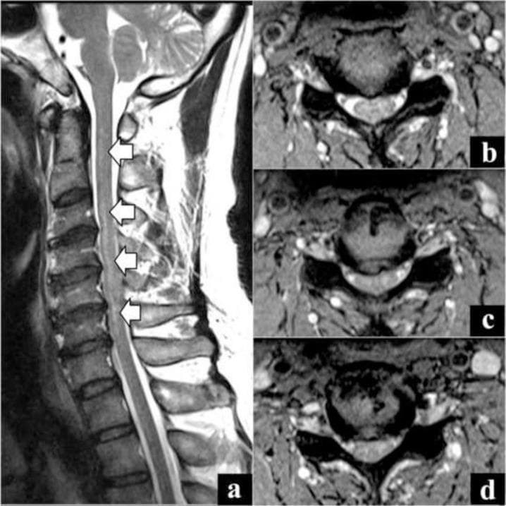 Magnetic Resonance Imaging (MRI) of the cervical spine illustrating a diagnostic view of transverse myelitis. Image (a) is a sagittal T2-weighted sequence showing extensive, longitudinal intramedullary hyperintensity within the spinal cord extending from the C2 to C7 levels, marked by white arrows. This indicates significant edema or inflammation without significant cord expansion. Images (b), (c), and (d) provide axial T2-weighted cross-sections at the C3-C4, C4-C5, and C5-C6 levels respectively. These axial views demonstrate a central, bright signal change within the cord parenchyma that appears hyperintense relative to normal cord tissue and is similar in intensity to the surrounding cerebrospinal fluid (CSF). There is mild evidence of spinal canal stenosis, but the primary pathology is the centrally located, diffuse signal abnormality. The findings are characteristic of longitudinal extensive transverse myelitis (LETM), often used in the differential diagnosis of neuroinflammatory conditions such as Neuromyelitis Optica (NMO) or multiple sclerosis.