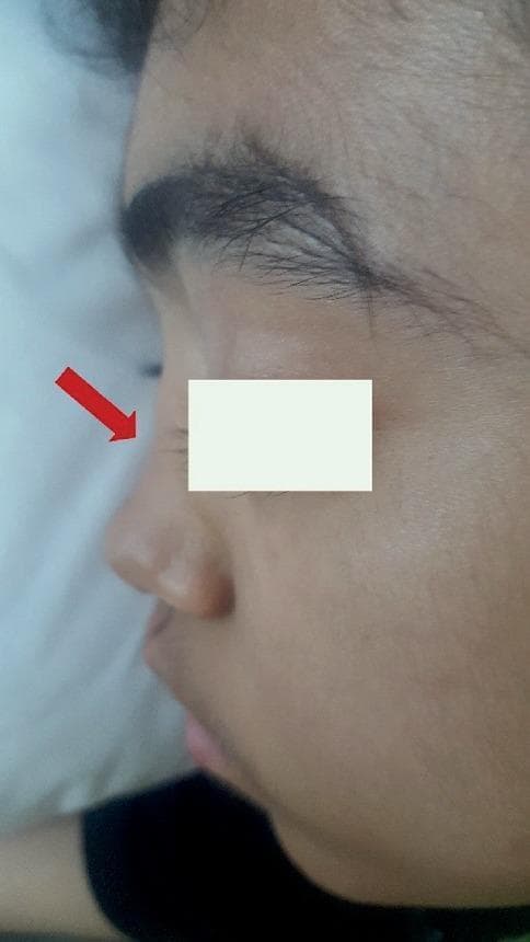 A clinical photograph showcasing a lateral (profile) view of a patient's face, specifically highlighting a significant nasal deformity. A red arrow points to a distinct depression and flattening of the nasal dorsum, characteristically known as a 'saddle nose' deformity. This structural collapse involves the loss of height in the cartilaginous bridge, creating a concave appearance between the nasal root and the tip, while the tip itself remains relatively defined. The image illustrates a classic physical finding associated with granulomatosis with polyangiitis (formerly Wegener granulomatosis), where chronic inflammation and destruction of the nasal septal cartilage lead to the bridge's collapse. The skin over the area remains intact, with the primary finding being the underlying skeletal/cartilaginous alteration. This visual is an essential diagnostic sign in rheumatology and otolaryngology for identifying systemic vasculitis affecting the upper respiratory tract.