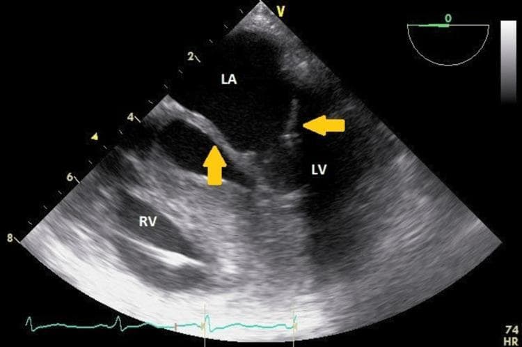 Diagnostic Image: This is a transesophageal echocardiogram (TEE) in a modified mid-esophageal 5-chamber view, demonstrating significant valvular pathology. Anatomical landmarks include the left atrium (LA), left ventricle (LV), and right ventricle (RV). The focus is on the mitral valve, where yellow arrows highlight severely thickened mitral valve leaflets. The leaflets exhibit increased echogenicity and a dense, infiltrated appearance, characteristic of glycosaminoglycan (GAG) deposition. Functionally, the image captures a diastolic frame showing restricted opening and characteristic 'doming' of the mitral leaflets, indicative of moderate mitral stenosis. This visual evidence supports a diagnosis of valvular infiltration, commonly seen in metabolic storage disorders such as mucopolysaccharidosis. The image is a critical educational tool for identifying non-calcific valvular thickening and restricted diastolic excursion in echocardiography.