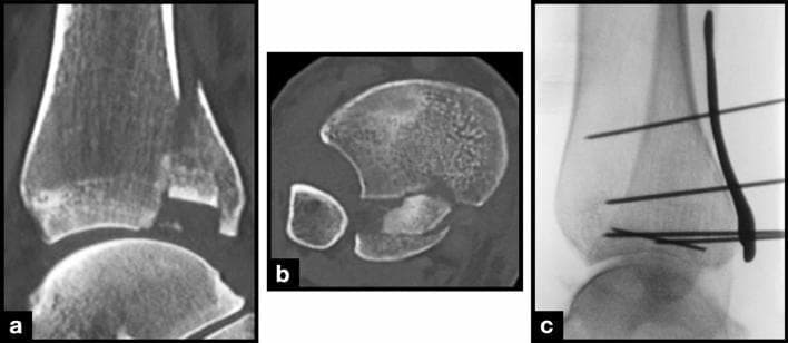 This composite figure illustrates a complex distal tibia fracture involving a dislocated intercalary fragment (ICF), presented through diagnostic imaging and intraoperative fluoroscopy. Panel (a) is a sagittal CT scan showing a large, displaced ICF at the distal tibia with a prominent fracture gap relative to the main tibial shaft and articular surface. Panel (b) provides an axial CT view demonstrating that the ICF consists of multiple distinct fragments dislocated anteriorly and medially, with the medial malleolus and fibula remaining visible for anatomical reference. Panel (c) is a lateral intraoperative X-ray (fluoroscopy) depicting the surgical stabilization of the fracture. The fixation strategy utilizes multiple Kirschner wires (K-wires) placed at varying trajectories to transfix the ICF, alongside a temporary anterior plate also secured with K-wires. These images demonstrate key clinical features of pilon or distal tibial plafond fractures, highlighting the challenges of reducing and fixing small, intra-articular intercalary bone fragments to restore joint congruency.