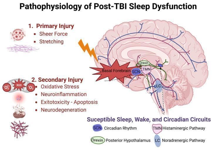 A pathophysiology diagram illustrating the mechanisms of sleep dysfunction following Traumatic Brain Injury (TBI). The central element is a sagittal anatomical diagram of the human brain, highlighting 'Susceptible Sleep, Wake, and Circadian Circuits.' Key neuroanatomical structures indicated include the Suprachiasmatic Nucleus (SCN) for circadian rhythm, the Tuberomammillary Nucleus (TMN) for the histaminergic pathway, Orexin neurons in the posterior hypothalamus, and the Locus Coeruleus (LC) for the noradrenergic pathway. Blue and purple axonal projections are shown extending from these nuclei toward the cortex and brainstem. The diagram categorizes TBI into two phases: 1) Primary Injury, characterized by mechanical 'Sheer Force' and 'Stretching' at the skull base and basal forebrain, and 2) Secondary Injury, involving biochemical cascades such as Oxidative Stress (reactive oxygen species), Neuroinflammation, Excitotoxicity/Apoptosis, and chronic Neurodegeneration. This visual serves as an educational model for how traumatic mechanical disruption and subsequent cellular injury impair the regulatory networks of the sleep-wake cycle.