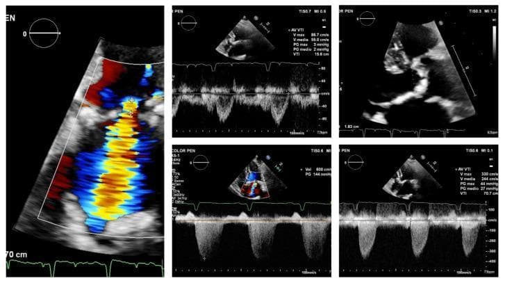 This composite diagnostic image displays multiple echocardiographic views evaluating a patient with concomitant severe aortic stenosis (AS) and mitral regurgitation (MR). The panel on the left features a color Doppler assessment of a mitral regurgitant jet, demonstrating high-velocity, turbulent flow characterized by a central yellow-red mosaic pattern transitioning to blue at the periphery, originating from the mitral valve into the left atrium. The top-right and middle-right panels provide 2D anatomical views and pulsed-wave Doppler (PWD) of the left ventricular outflow tract (LVOT). The bottom panels display spectral Doppler tracings used for hemodynamic quantification. The continuous-wave Doppler (CWD) of the aortic valve shows a peak velocity (Vmax) of 330 cm/s and a mean pressure gradient (MPG) of 27 mmHg, while the mitral jet velocity is recorded at 600 cm/s (6 m/s). This multi-modal ultrasound study illustrates a paradoxical low-flow, low-gradient AS phenotype where the severe MR complicates the estimation of AS severity due to reduced forward stroke volume and altered jet momentum flux.