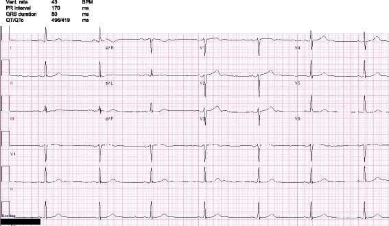 A 12-lead electrocardiogram (ECG) printed on standard grid paper demonstrating a primary finding of sinus bradycardia. The tracing displays leads I, II, III, aVR, aVL, aVF, and V1-V6, along with a continuous rhythm strip of lead II at the bottom. The ventricular rate is notably slow at approximately 43 beats per minute (BPM). Each QRS complex is preceded by a normal P wave with a consistent PR interval of 170 ms, confirming a sinus rhythm. The QRS duration is within normal limits at 80 ms, and the QTc interval is 419 ms. Waveform morphology across all leads shows no significant ST-segment elevation, ST-depression, or T-wave inversions. This diagnostic image is representative of symptomatic bradycardia, in this clinical context associated with medication-induced (clonidine) effects. The image is intended for medical education regarding heart rate interpretation and basic arrhythmia recognition.