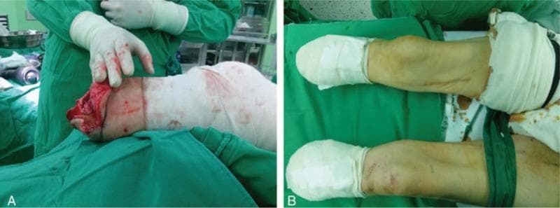 Clinical photograph in two panels (A and B) demonstrating a bilateral transtibial (below-knee) amputation procedure in a surgical setting. Panel A shows an intraoperative view of the right lower extremity during the amputation process. Visible features include exposed muscle, bone, and vascular tissues at the distal stump, with blood-stained surgical drapes and a gloved surgeon's hand stabilizing the limb. Panel B illustrates the postoperative result for both the left and right legs. Both stumps are now surgically closed and encased in clean, white pressure dressings. A green pneumatic tourniquet or Esmarch bandage is visible on the upper thigh of one limb to maintain hemostasis. Both images show the patient positioned on a green sterile surgical drape. The content illustrates the progression from an active surgical resection to the final stabilized postoperative state of bilateral residual limbs, relevant for surgical education, anesthesia management (CFSNBs), and perioperative care training.
