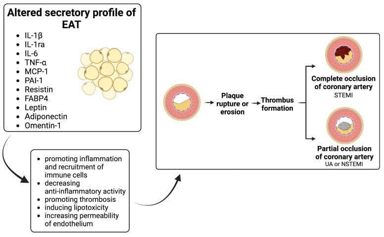 This pathophysiology diagram illustrates the link between the altered secretory profile of epicardial adipose tissue (EAT) and the pathogenesis of acute coronary syndrome (ACS). The left panel lists inflammatory cytokines and adipokines secreted by EAT, including IL-1Ξ², IL-6, TNF-Ξ±, MCP-1, Resistin, FABP4, and Leptin, alongside anti-inflammatory factors like Adiponectin and Omentin-1. An arrow indicates how these secretions promote inflammation, immune cell recruitment, thrombosis, lipotoxicity, and increased endothelial permeability. The right panel depicts the progression of coronary artery disease: starting from an artery with a stable atherosclerotic plaque, the process advances through plaque rupture or erosion to thrombus formation. This culminates in two clinical outcomes: complete coronary artery occlusion, leading to ST-elevation myocardial infarction (STEMI), and partial occlusion, leading to unstable angina (UA) or non-ST-elevation myocardial infarction (NSTEMI). The diagram utilizes cross-sectional anatomical illustrations of coronary arteries to show varying degrees of luminal narrowing and thrombus size.