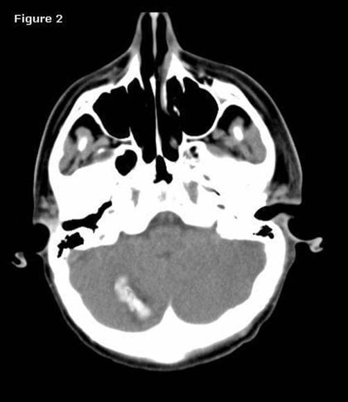 This diagnostic image is an axial non-contrast computed tomography (CT) scan of the brain at the level of the posterior fossa and skull base. The primary finding is an area of hyperdensity in the right cerebellar hemisphere, measuring approximately 15 x 20 mm, which is consistent with an acute intracerebellar hemorrhage. The hemorrhage appears somewhat linear and is localized within the cerebellar folia. Evaluation of the surrounding brain tissue reveals diffuse decreased parenchymal density and effacement of the sulcal spaces and cisterns, suggestive of significant cerebral edema. Visible anatomical landmarks include the sphenoid sinus, ethmoid air cells, and the bony structures of the skull base. This scan illustrates a potential postoperative complication (remote cerebellar hemorrhage) following supratentorial neurosurgery. The target audience for this educational material includes neurosurgery residents and radiology students studying postoperative complications and intracranial pathology.