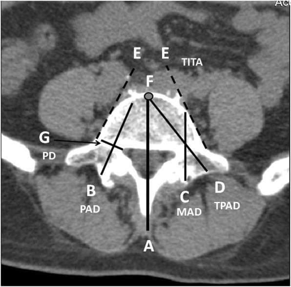 This diagnostic image is an axial computed tomography (CT) scan of a human lumbar vertebra, overlaid with a schematic diagram illustrating morphometric parameters essential for pedicle screw placement. The anatomical region focuses on the vertebral body, pedicles, and spinal canal. Key labeled parameters include: (A) the antero-posterior (AP) midline axis; (B) the longitudinal pedicle axis; and (G) the pedicle diameter (PD), measured perpendicular to the pedicle axis. Distance measurements shown include the Pedicle Axis Distance (PAD, line B), the Midline Axis Distance (MAD, line C) from the lamina to the anterior cortex, and the Transverse Pedicle Axis Distance (TPAD, line D) from the transverse process-pedicle interface to the anterior cortex. The Transverse Intertangential Angle (TITA) is formed by lateral tangential lines (E) along the vertebral body borders. Point F marks the anterior border of the midline axis, serving as the target endpoint for the Weinstein method of screw insertion. This educational diagram is used in orthopedic surgery and radiology to standardize measurements for safe surgical trajectories and to avoid iatrogenic complications.