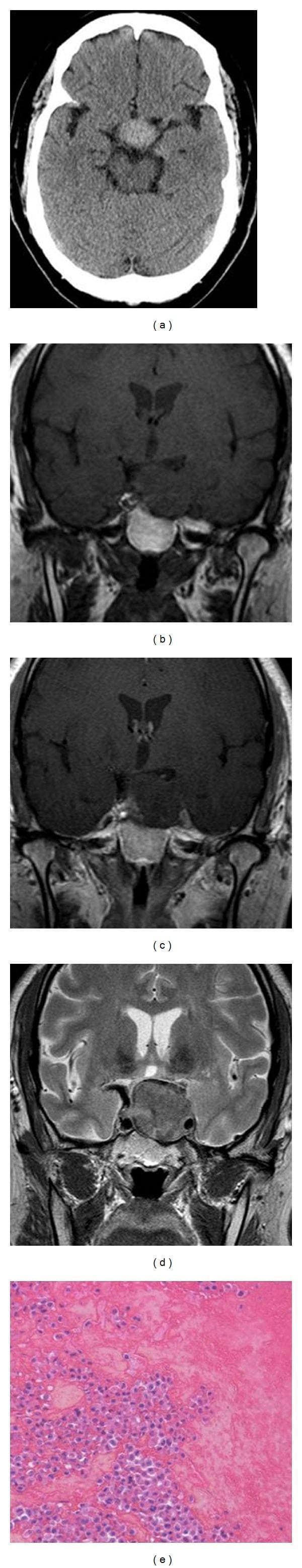 This composite figure presents a clinical case of pituitary apoplexy through multimodality imaging and histopathology. Panel (a) is an axial non-contrast CT scan showing a hyperdense mass in the sellar/suprasellar region, characteristic of acute intratumoral hemorrhage. Panels (b) and (c) are coronal T1-weighted MRI scans; (b) shows a large, pre-contrast hyperintense pituitary tumor extending into the suprasellar cistern, while (c) demonstrates a lack of internal enhancement following gadolinium administration, indicative of tumor infarction or necrosis. Panel (d) is a coronal T2-weighted MRI revealing a heterogeneous tumor with a prominent low-signal-intensity (hypointense) peripheral rim, a classic sign of hemosiderin deposition or acute-on-chronic bleeding in pituitary apoplexy. Panel (e) provides a histopathological correlation with hematoxylin and eosin (H&E) staining, showing a clear demarcation between viable papillary-patterned pituitary adenoma tissue (left) and areas of extensive hemorrhage and necrosis (right). The sequence illustrates the diagnostic hallmark of sudden hemorrhagic transformation of a macroadenoma.