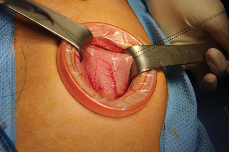 This clinical photograph captures an intraoperative view of a mini-laparotomy. A circular plastic wound retractor is positioned within the abdominal incision to provide circumferential exposure and protect the wound edges. Centered within the retractor, the anterior wall of the stomach is visible, characterized by a smooth, moist, pinkish-white serosal surface with prominent, branching intramural vascular structures. Two metallic hand-held retractors are used to further elevate and stabilize the gastric tissue. Two interrupted black silk stay sutures have been placed through the seromuscular layer of the stomach wall, serving as traction points to facilitate surgical manipulation and prepare for gastrotomy. The surrounding field is draped with sterile blue surgical covers. This image demonstrates standard surgical techniques for organ exposure and stabilization during a procedure such as a gastric trichobezoar removal.