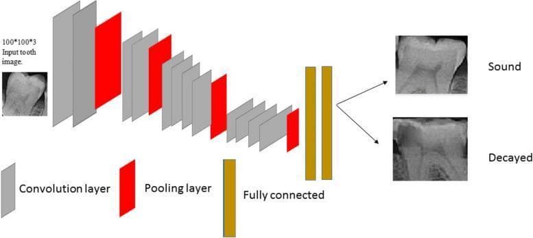 This diagram illustrates a deep learning architecture for dental diagnostic imaging, specifically a VGG18 convolutional neural network (CNN) optimized for caries detection. The workflow begins with an input dental radiograph (bitewing or periapical) resized to a 100x100x3 pixel array. The process transitions through a series of hierarchical layers represented by color-coded blocks: grey blocks signify convolution layers for feature extraction (e.g., detecting edges and textures of enamel and dentin), while red blocks represent max-pooling layers for spatial dimensionality reduction. The network architecture culminates in two yellow rectangular blocks representing fully connected layers that integrate high-level features for classification. The final output is a binary classification illustrated by radiographic images of teeth labeled 'Sound' (healthy tooth structure) or 'Decayed' (exhibiting radiolucent areas indicative of dental caries). This visualization demonstrates the application of artificial intelligence in oral and maxillofacial radiology for automated pathology detection.