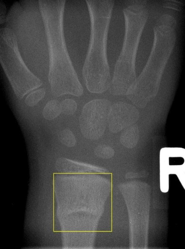 This diagnostic X-ray image (radiography) captures the pediatric wrist and hand, focusing on the distal forearm. The imaging demonstrates a buckle fracture, also known as a torus fracture, of the distal radius metaphysis. Visually, this is characterized by a subtle outward bulging or buckling of the cortical surface without a complete cortical break, typically occurring due to axial compression loads in children with relatively pliable bones. The fracture is localized within the metaphyseal region of the radius, identified here by a yellow bounding box. There is no significant angulation or displacement of the bone, and the distal ulna, carpal bones, and growth plates appear intact and well-aligned. This image is an educational example of a common pediatric orthopedic injury, illustrating the characteristic 'buckle' morphology used for clinical classification and diagnostic identification in emergency and pediatric medicine.
