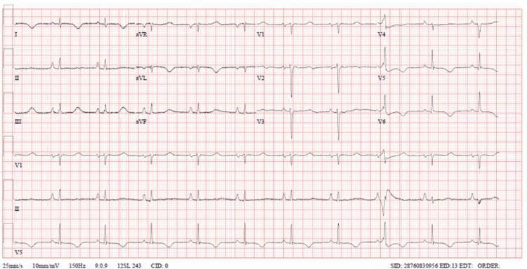 A standard 12-lead electrocardiogram (ECG) displayed on a pink grid background, captured at a paper speed of 25 mm/s and voltage of 10 mm/mV. The tracing demonstrates classic findings of a Left Bundle Branch Block (LBBB). Key visual features include a widened QRS complex duration exceeding 120 ms (3 small squares). Predominantly negative QRS deflections with deep S-waves are visible in the anterior precordial leads (V1, V2, and V3). In contrast, the lateral leads (I, aVL, V5, and V6) show broad, monomorphic, and predominantly positive R-waves. Secondary ST-segment and T-wave abnormalities are present, characterized by ST-segment depression and T-wave inversion in the lateral leads, which are typically discordant to the QRS vector in LBBB. This diagnostic image is an educational example of intraventricular conduction delay, used to teach medical students and residents how to identify bundle branch blocks and differentiate them from acute ischemic events.