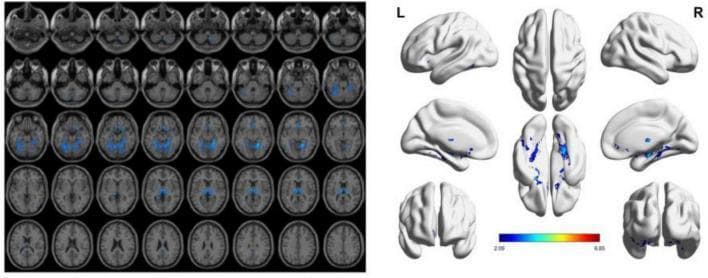 This diagnostic image displays Voxel-Based Morphometry (VBM) results derived from functional and structural MRI, illustrating gray matter atrophy in patients with Vascular Dementia (VD) compared to those with Vascular Cognitive Impairment No Dementia (VCIND). The left panel consists of a montage of axial brain slices displaying statistically significant areas of atrophy (p < 0.05) highlighted in blue. These blue-shaded regions are primarily concentrated in subcortical structures, including the thalamus and basal ganglia, as well as portions of the cerebellum. The right panel shows three-dimensional cortical surface renderings from lateral, medial, dorsal, and ventral perspectives. These renderings further localize atrophy to the bilateral fusiform gyri, lingual gyri, and inferior temporal regions, with a color scale bar indicating statistical intensity ranging from 2.09 to 6.85. The visualization demonstrates the pattern of progressive neurodegeneration characteristic of vascular cognitive decline, highlighting both deep gray matter and cortical involvement.