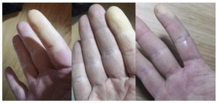 This clinical photograph set comprises three panels illustrating classic Raynaud's phenomenon in the fingers. The images demonstrate significant vascular changes characterized by episodic digital ischemia. Specifically, multiple fingers exhibit distinct, sharply demarcated areas of pallor (whitening), primarily involving the distal phalanges. This chalk-white appearance indicates a complete lack of blood flow due to vasospasm. Adjacent to the ischemic zones, the skin displays a mix of cyanosis (bluish tint) and reactive hyperemia (erythema or redness), showcasing the characteristic triphasic color response. The distribution is asymmetrical across the digits. Skin texture appears slightly taut in the pale areas, with normal dermatoglyphics visible in the unaffected regions. This visual is highly representative of secondary Raynaud's phenomenon, often seen in systemic autoimmune diseases such as systemic sclerosis or idiopathic inflammatory myopathies (IIMs). It serves as a key diagnostic clinical sign for medical students and clinicians assessing peripheral vascular and rheumatological disorders.