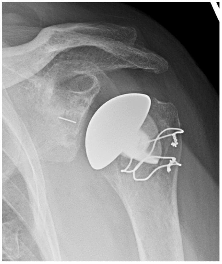 Anteroposterior (AP) radiographic view of the shoulder demonstrating a stemless anatomic Total Shoulder Arthroplasty (TSA). The humeral component is a stemless, radiopaque, bulbous implant positioned at the proximal humeral head, avoiding the need for medullary extension into the humeral shaft. Visible cerclage wires or heavy suture anchors are present at the lateral aspect of the humerus, likely securing a tuberosity osteotomy or soft tissue repair. The glenoid side shows a prosthetic interface with a central radiopaque marker pin or keel visible within the glenoid vault. The acromion, clavicle, and scapular spine are well-visualized and intact. This diagnostic image illustrates a modern orthopaedic technique for shoulder replacement that preserves proximal humeral bone stock, typically indicated in patients with adequate bone quality for metaphyseal fixation.