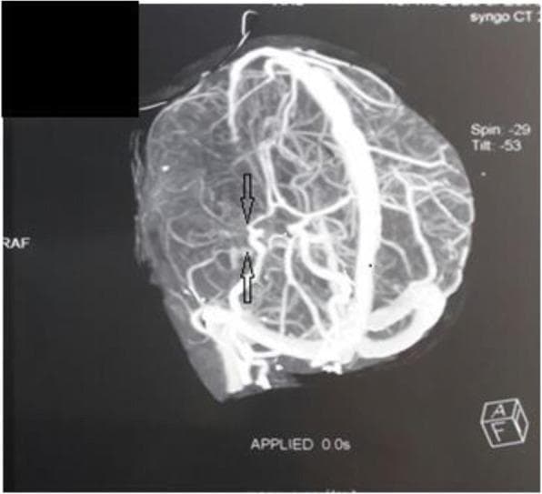 This diagnostic image is a cerebral angiogram (CT angiography) at the level of the circle of Willis, illustrating a classic presentation of Moyamoya disease. The visual highlights a proximal obliteration or severe stenosis of the right middle cerebral artery (MCA), marked by black arrows. Distal to the site of occlusion, there is a dense, hazy network of fine collateral vessels. This cluster of small, anastomotic vessels creates the pathognomonic 'puff of smoke' (moyamoya) appearance, which develops as a compensatory mechanism for the chronic, progressive narrowing of the major intracranial arteries. The image demonstrates significant vascular remodeling and diminished vessel caliber in the primary arterial territory. This finding is clinically significant for the evaluation of pediatric stroke and ischemic risk, representing a primary vasculopathy that affects the internal carotid arteries and their branches.