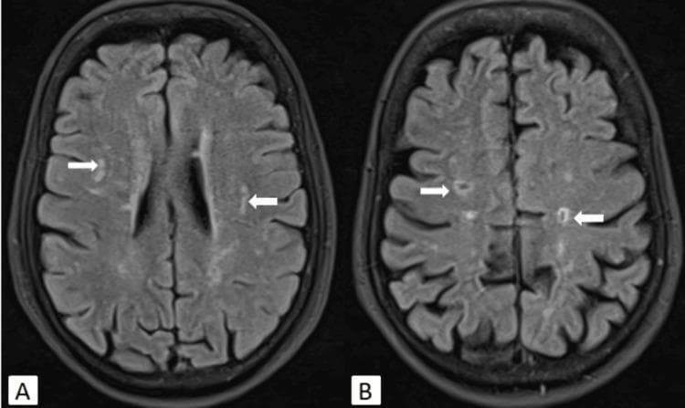 This diagnostic image consists of two axial Fluid-Attenuated Inversion Recovery (FLAIR) MRI scans of the brain, labeled A and B, demonstrating chronic cerebrovascular pathology. Image A shows bilateral, multifocal hyperintense signal foci within the periventricular white matter and centrum semiovale (indicated by white arrows). These findings are characteristic of chronic small vessel ischemic changes, often graded using the Fazekas scale. Image B displays similar anatomical regions but highlights specific old lacunar infarcts. These are distinguished by central hypointensities (representing fluid-filled cavities) surrounded by a rim of hyperintense gliosis. The lesions are distributed symmetrically across the white matter tracts. These images serve as an educational example of the radiological progression from diffuse white matter hyperintensities to discrete lacunar infarctions in the context of chronic ischemia. The content is suitable for medical students and neurology residents studying neuroimaging of vascular dementia and small vessel disease.