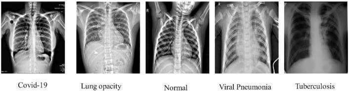 A comparison chart consisting of five posteroanterior (PA) chest X-ray (CXR) images illustrating different pulmonary conditions for educational classification. Each diagnostic image represents a specific clinical entity: (1) COVID-19: Shows subtle, patchy bilateral ground-glass opacities, primarily in the lower lung zones. (2) Lung Opacity: Features a prominent, well-defined consolidation in the right lower lobe, partially obscuring the diaphragmatic contour. (3) Normal: Demonstrates clear lung fields, sharp costophrenic angles, and normal mediastinal and cardiac silhouettes. (4) Viral Pneumonia: Exhibits diffuse, bilateral interstitial infiltrates and peribronchial thickening throughout the lung parenchyma. (5) Tuberculosis: Displays characteristic fibrotic changes and suspected cavitary lesions localized to the upper lobes. The images highlight key radiological differences in pulmonary pathology, including distribution (focal vs. diffuse), density, and anatomical predilection, which are essential for differential diagnosis in respiratory medicine and radiology training.